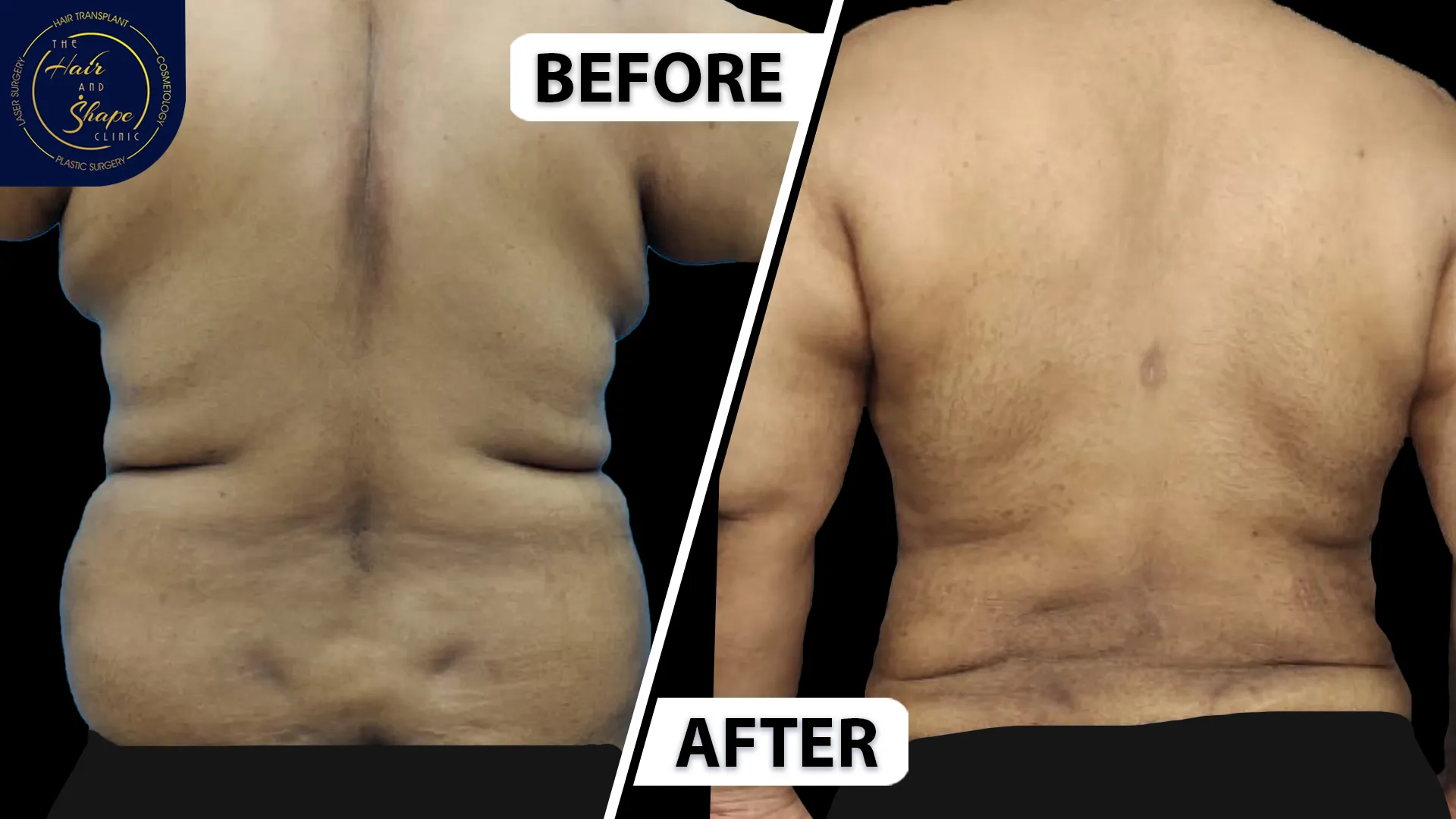 Back Liposuction result3